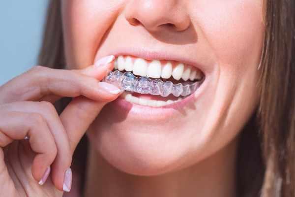 Invisalign Stockport